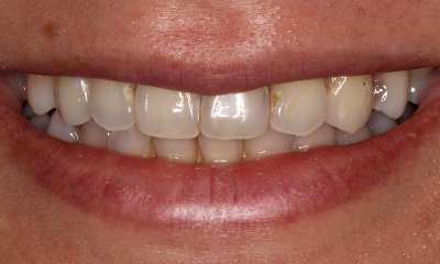 dull smile before teeth whitening