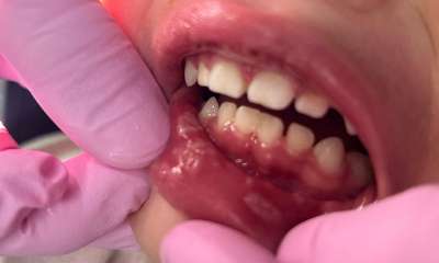 gums before laser dentistry