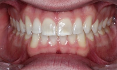 Before non-invasive composite veneers showing uneven front teeth and visible discoloration in Houston, TX