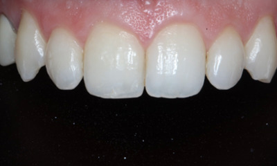 Before Bioclear treatment showing peg lateral teeth and uneven smile proportions in Houston, TX