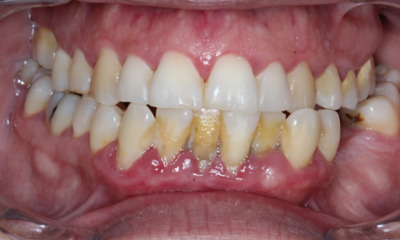 Before treatment - Periodontal Therapy
