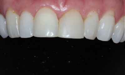 Before treatment - Replaced Old Bondings with Bioclear Composite Veneers
