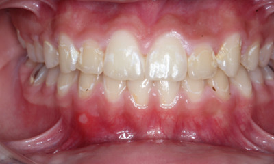 Before treatment - Restoration and Rejuvenation with Non-invasive Bioclear Composite Veneers 