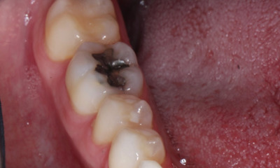 Safe-Mercury-Amalgam-Removal-Technique-SMART-Before-Image