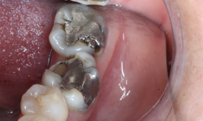 SMART-and-Bioclear-Overlay-Before-Image
