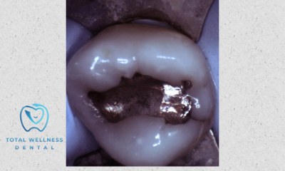 Before SMART mercury removal showing silver amalgam filling in a molar tooth in Houston, TX