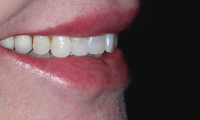 Before treatment - Smile Design