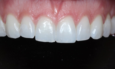 Before Bioclear composite veneers showing worn teeth, uneven contours, and smile asymmetry in Houston, TX