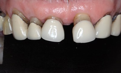 Smile-Makeover-with-Porcelain-Restorations-Before-Image