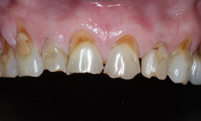 Before treatment - Smile Rejuvenation with Bioclear Composite Veneers