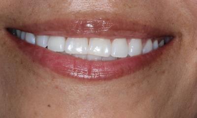 Before Bioclear smile rejuvenation showing worn upper front teeth and uneven incisal edges in Houston, TX