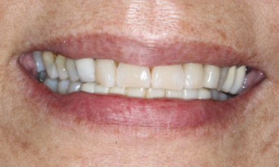 Before porcelain veneer treatment showing discoloration and uneven tooth shape at Total Wellness Dental in Houston, TX
