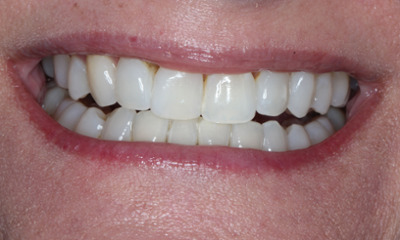 Close-up before Bioclear treatment showing worn tooth edges and uneven smile proportions in Houston, TX