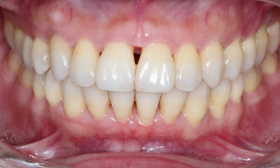 Before treatment - Closing Black Triangle with Bioclear Veneers