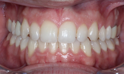 Before cosmetic treatment for peg laterals showing undersized lateral incisors in Houston, TX