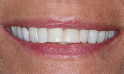 Before treatment - Replaced Old Bondings with Bioclear Composite Veneers
