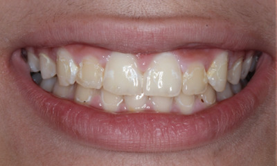 Before treatment - Restoration and Rejuvenation with Non-invasive Bioclear Composite Veneers 