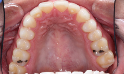 Before safe mercury amalgam removal showing multiple metal fillings on upper teeth in Houston, TX