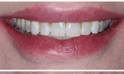 Before treatment - Smile Design