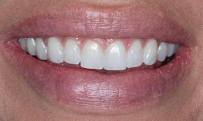 Before noninvasive smile rejuvenation showing worn tooth edges and uneven smile aesthetics in Houston, TX