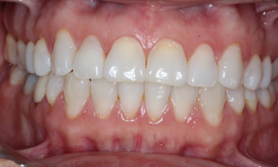 Before non-invasive Bioclear treatment showing worn central incisors and age-related tooth wear in Houston, TX