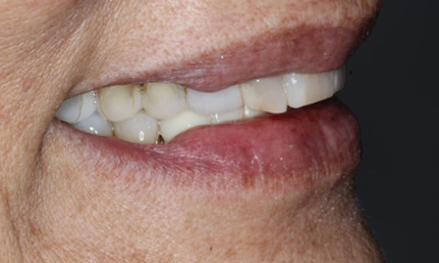 Side view before porcelain veneer smile transformation showing worn and uneven teeth in Houston, TX