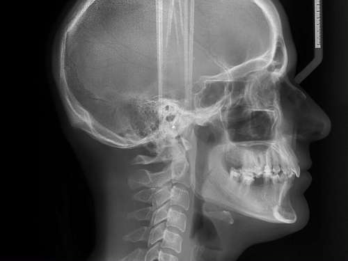 Cephalometric X-rays